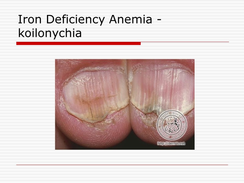 Iron Deficiency Anemia - koilonychia